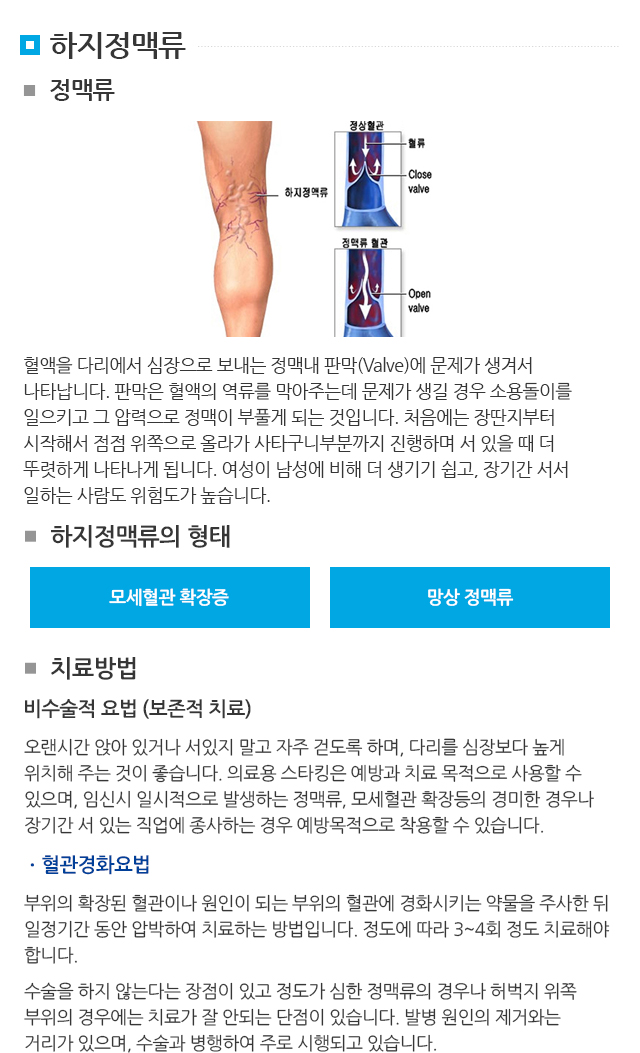 하지정맥류